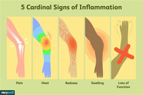 how many cheek kisses for arthritis inflammation causes