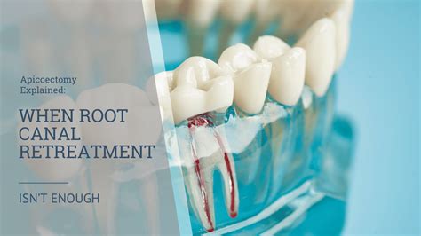 how much is root canal retreatment