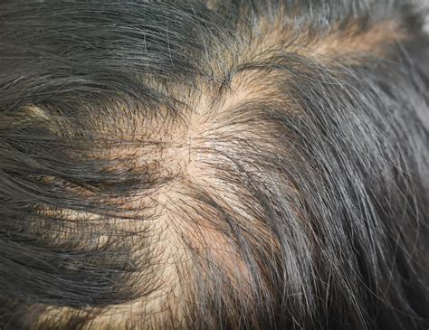 how much scalp should be visible