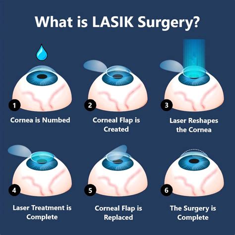 how much to get lasik