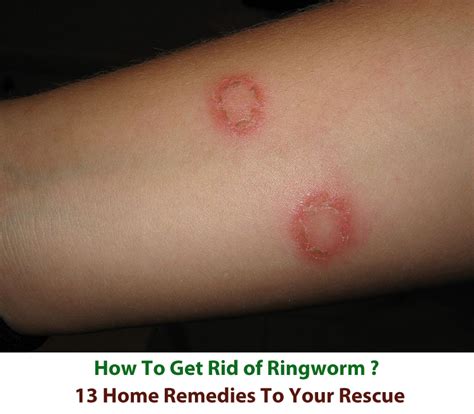 how quickly can you get ringworm