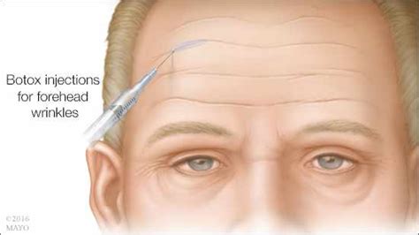 how safe is botox for wrinkles