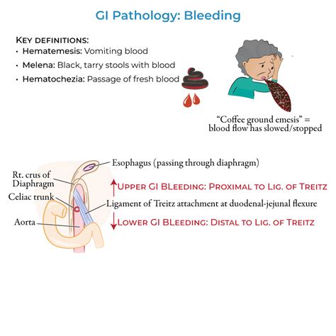 how serious is a gi bleed
