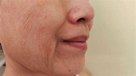 how to increase cheek elasticity