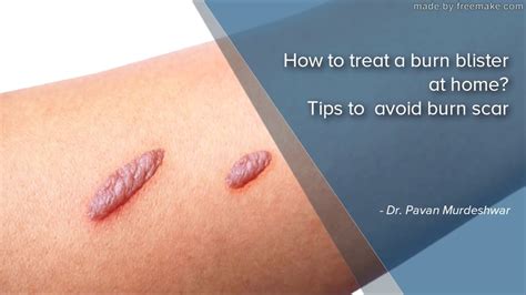 how to avoid burn blisters