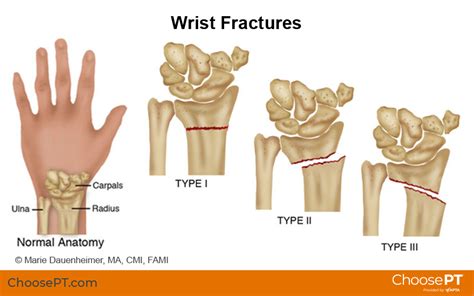 how to break your wrist in bed