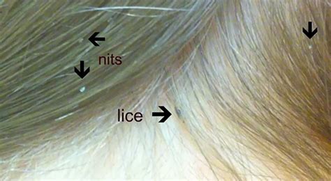 how to check toddler for head lice removal