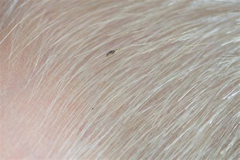 how to check toddler for head lice symptoms