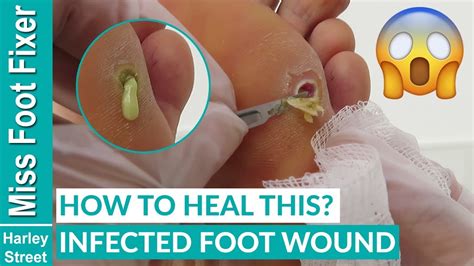 how to cure a wound with pus