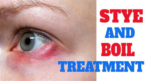 how to cure boil in eye
