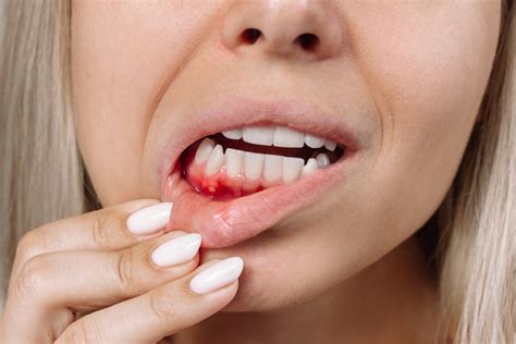 how to cure wound in lips