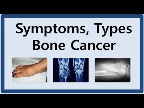 how to detect bone cancer in leg