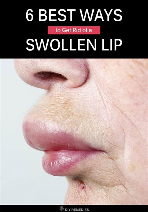 how to ease lip swelling fast