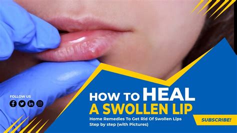 how to fix a swollen lip faster like