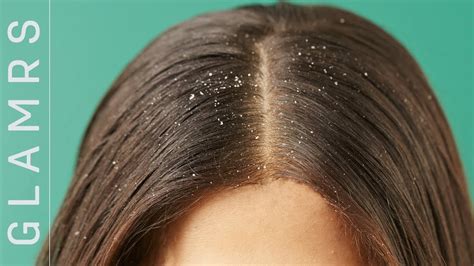 how to get dandruff out of black girl hair