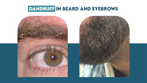how to get dandruff out of eyebrows