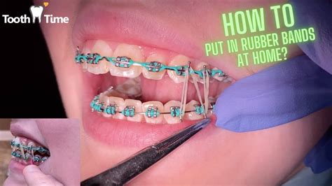 how to get elastics on braces at home