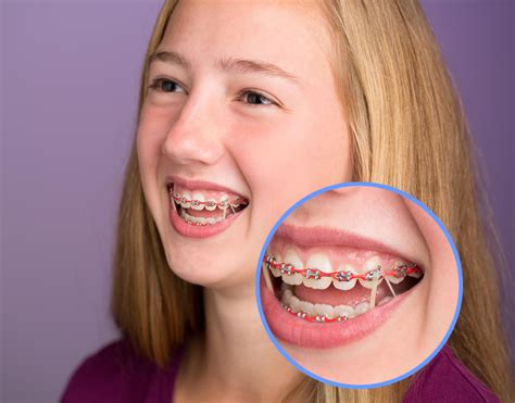 how to get elastics on braces for a