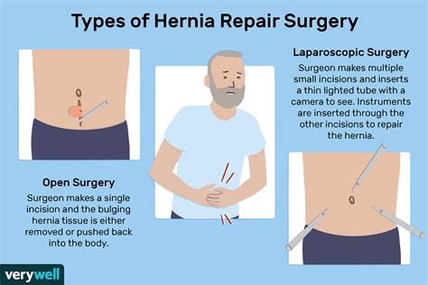 how to get free hernia surgery