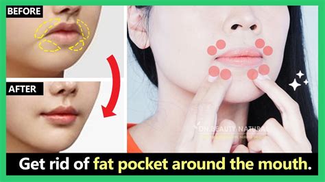 how to get rid of perioral mounds