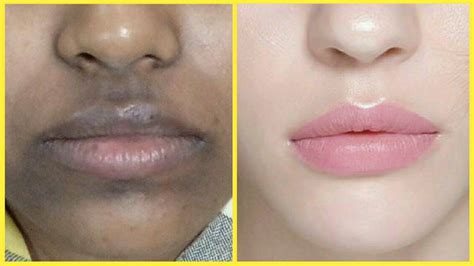 how to get rid of pigmentation under lips