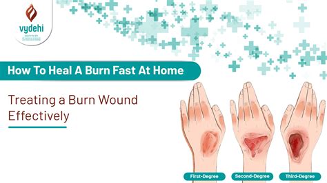 how to heal a bad burn fast