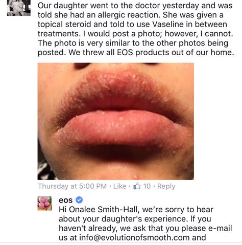 how to heal allergic reaction on lips
