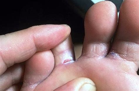 how to heal cut in between toes