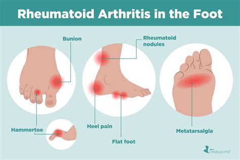 how to help arthritis in toes