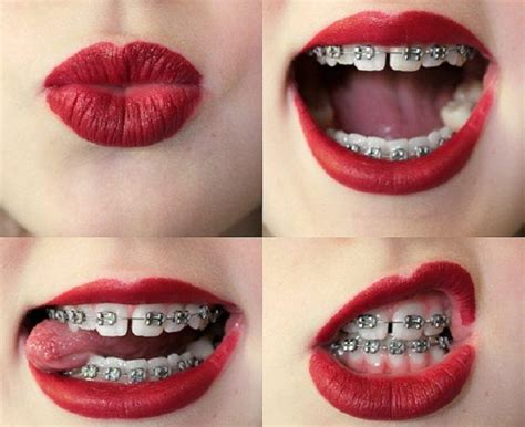 how to kiss well with braces