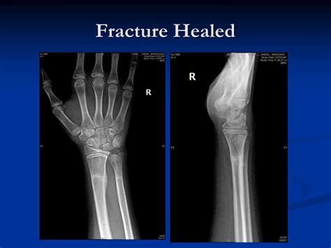 how to know fracture is healed