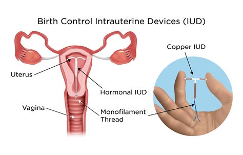 how to know if pregnant with iud
