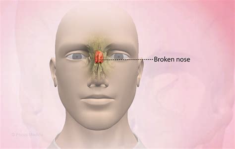 how to know if your nose broken