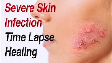 how to know when impetigo is healing