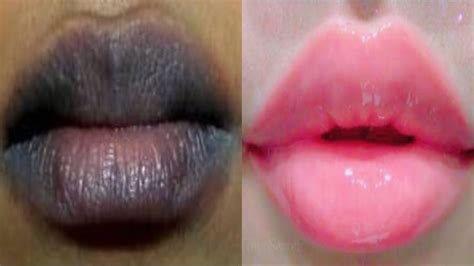 how to make dark lips pink again