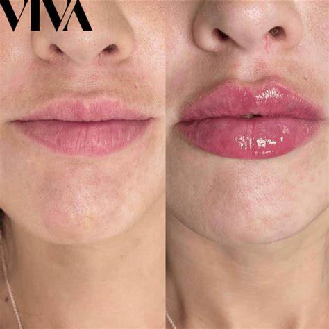 how to make lip fillers last longer men