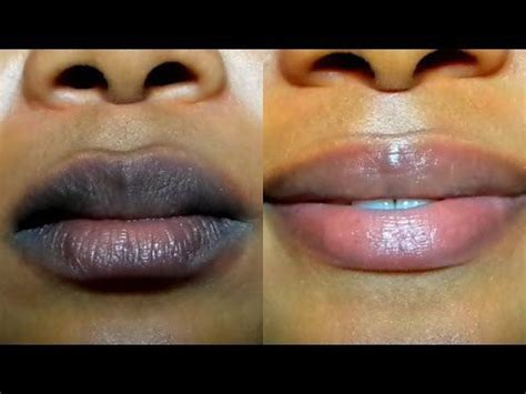 how to make my dark lips lighter symptoms