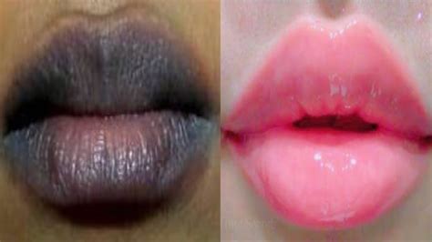 how to make my dark lips pink naturally