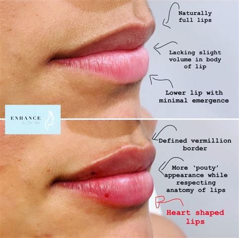 how to make your lips not puffy