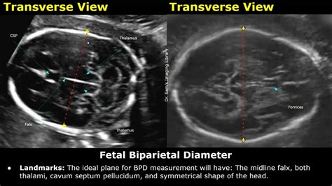 how to measure bpd in ultrasound
