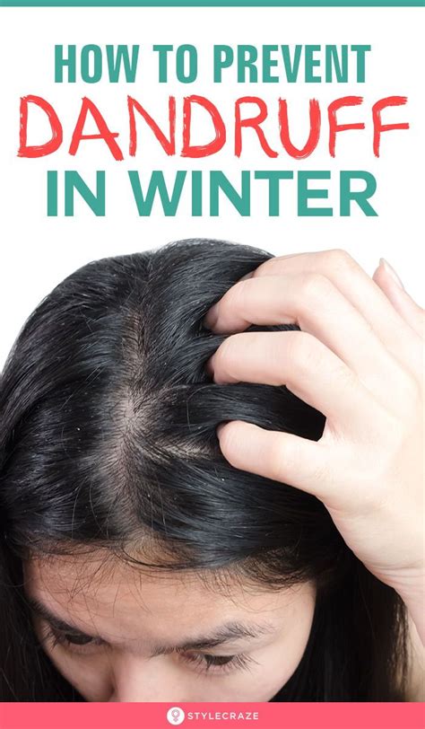 how to prevent dandruff in winters