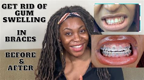 how to reduce gum swelling with braces fast