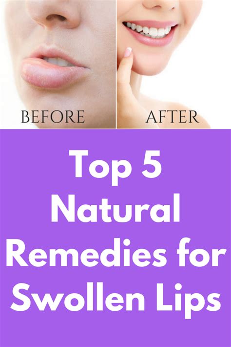 how to reduce lip swelling allergy remedies