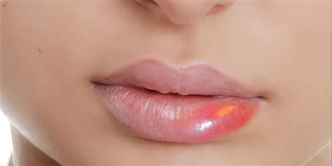how to reduce lip swelling from kissing faces