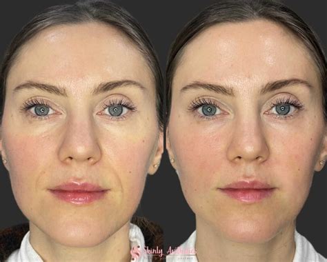 how to reduce swelling after dermal fillers removal
