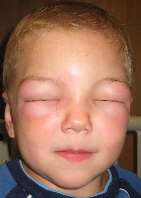 how to reduce swelling from allergic reaction