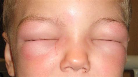 how to reduce swelling from allergic reaction