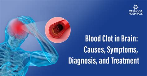 how to remove blood clot in brain