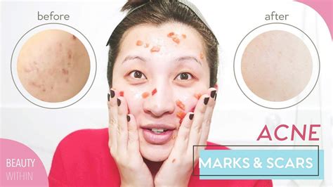 how to remove macham in face