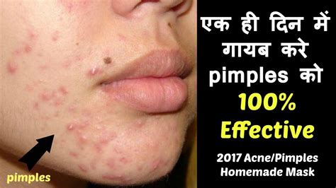 how to remove pimples in hindi